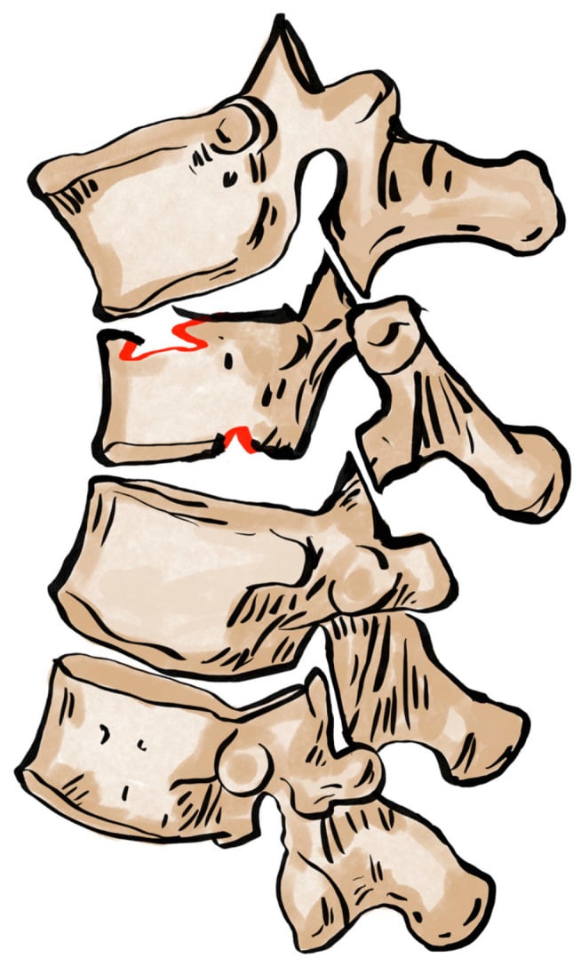 Illustration of intervertebral instability with fracture lines involving both endplates