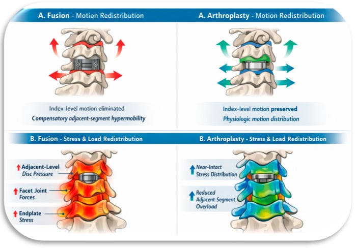 Comparison of cervical spinal fusion and motion-preserving arthroplasty showing load and motion redistribution