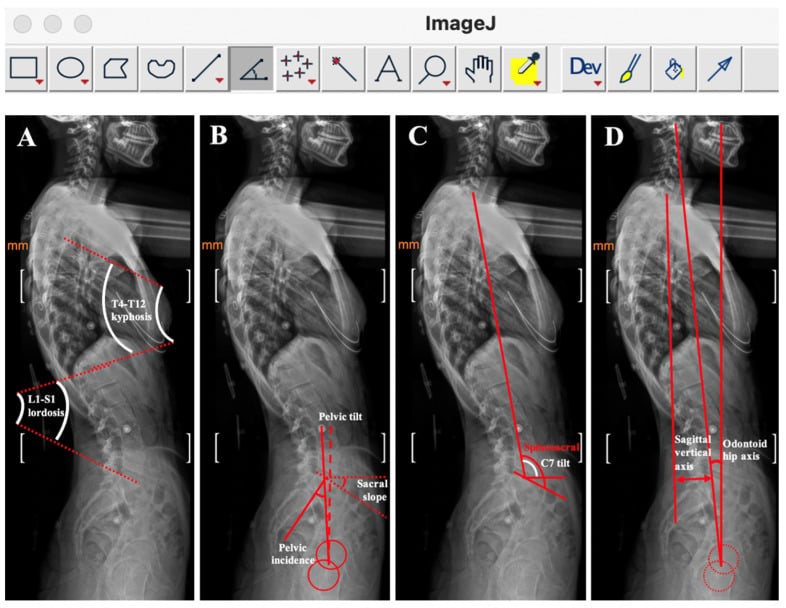 Standing lateral radiograph with thoracic kyphosis, lumbar lordosis and pelvic incidence measured