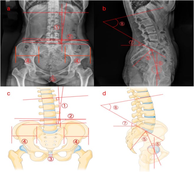 Standing anteroposterior and lateral radiographs with corresponding model diagrams and Cobb angle
