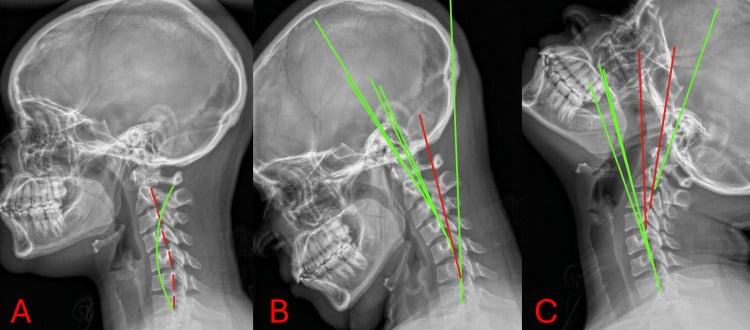 Lateral cervical radiographs in neutral, flexion and extension