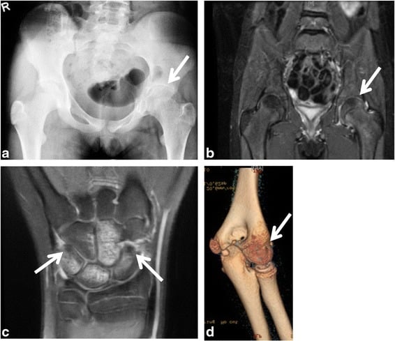 Four-panel imaging of severe monoarthritis in a child with oligoarticular JIA: pelvis radiograph, coronal MRI of the hip, coronal MRI of the wrist, and 3D CT of the elbow, each with an arrow marking the affected joint
