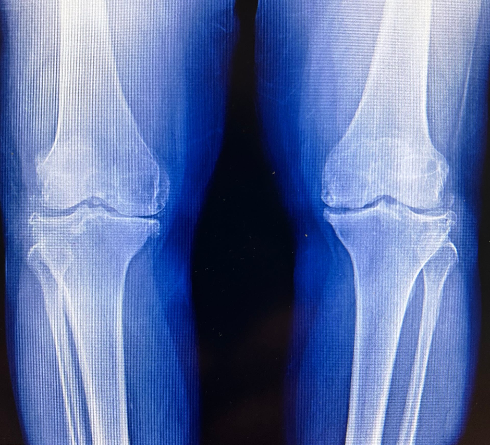 Weight-bearing AP radiographs of both knees with osteoarthritis showing medial joint-space narrowing, osteophytes and varus alignment.