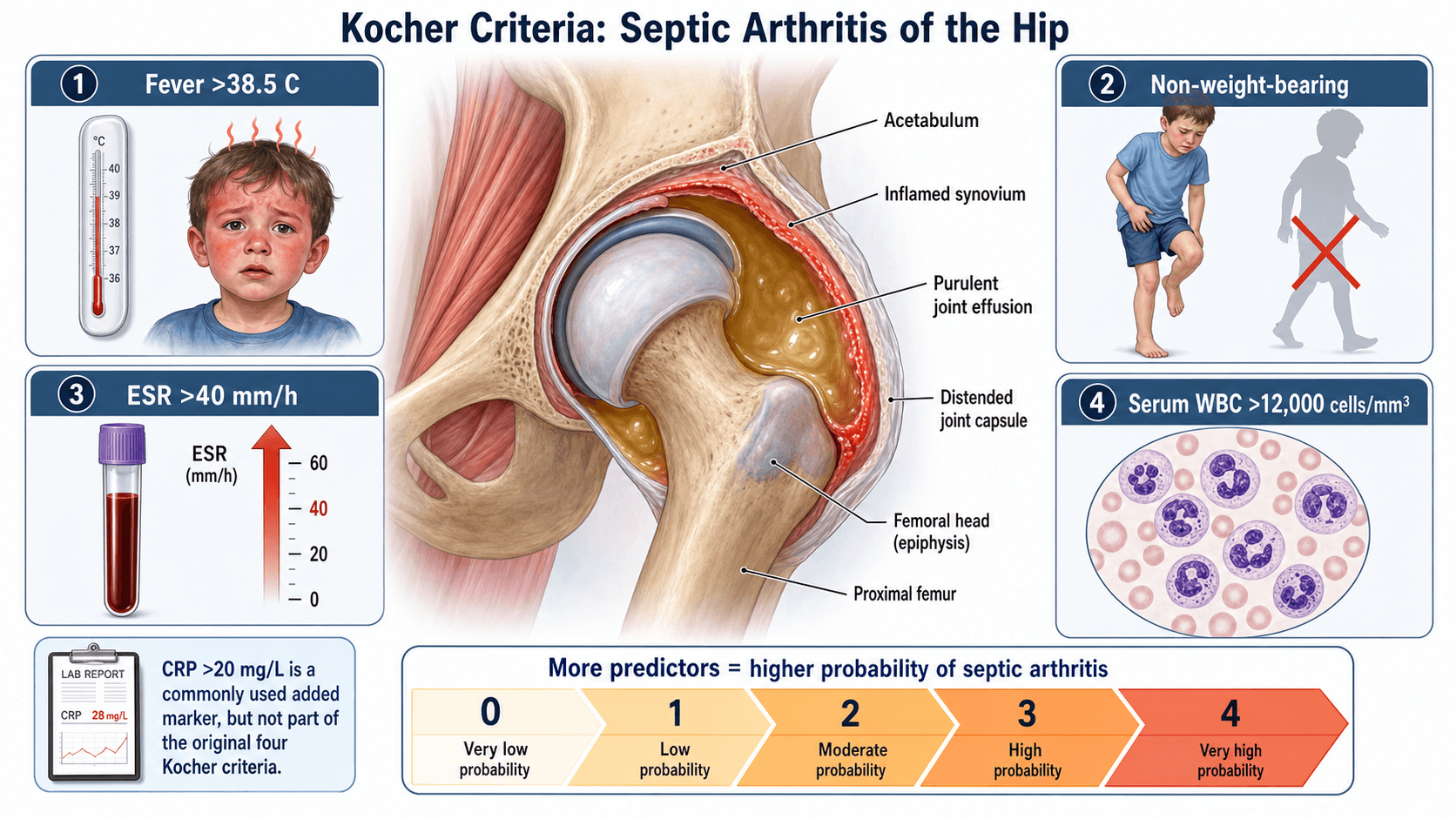 Kocher Criteria for septic arthritis of the hip: fever, non-weight-bearing, ESR, WBC, with a cross-section of an inflamed hip joint and a probability gradient