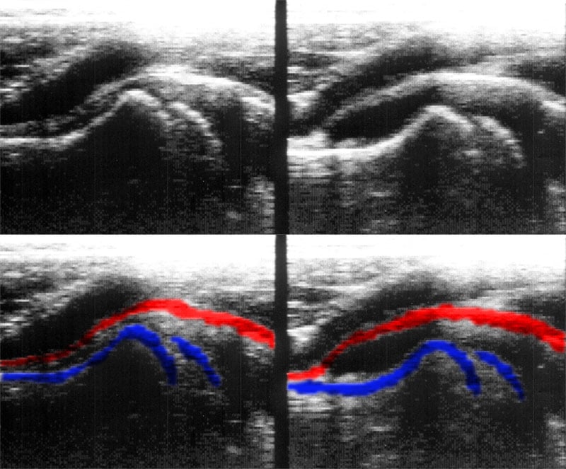Comparative anterior hip ultrasound of a child - a normal hip and an inflamed hip with a joint effusion distending the capsule