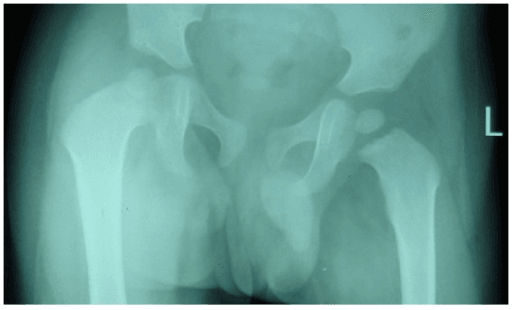 AP pelvis radiograph of a young child with an irritable hip; the capital femoral epiphyses are still largely unossified.