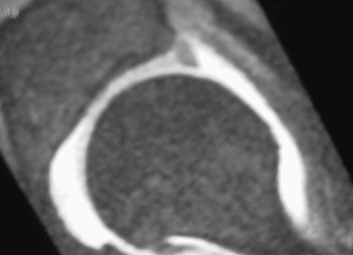 Axial MRI arthrogram of the hip demonstrating labral anatomy