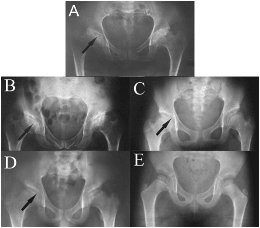 Series of AP pelvis radiographs of Legg-Calvé-Perthes disease