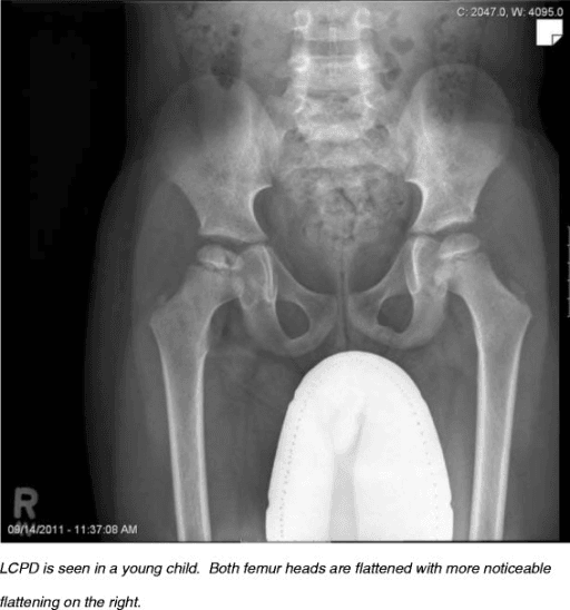 AP pelvis radiograph of a young child with bilateral Legg-Calvé-Perthes disease showing flattened femoral heads.