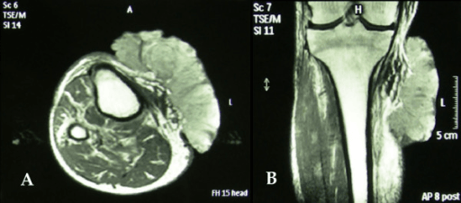Two-panel MRI of a lower limb leiomyosarcoma: axial slice (A) showing a soft tissue mass and coronal slice (B) of the lower leg with a 5 cm scale marker