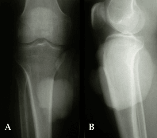 Two plain radiographs of the knee, anteroposterior (A) and lateral/oblique (B), showing a soft tissue density adjacent to the proximal tibia without obvious cortical destruction
