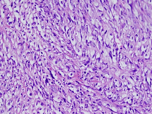 High-power H&E photomicrograph showing the pathology of leiomyosarcoma: interlacing fascicles of spindle cells with elongated eosinophilic cytoplasm and pleomorphic hyperchromatic nuclei