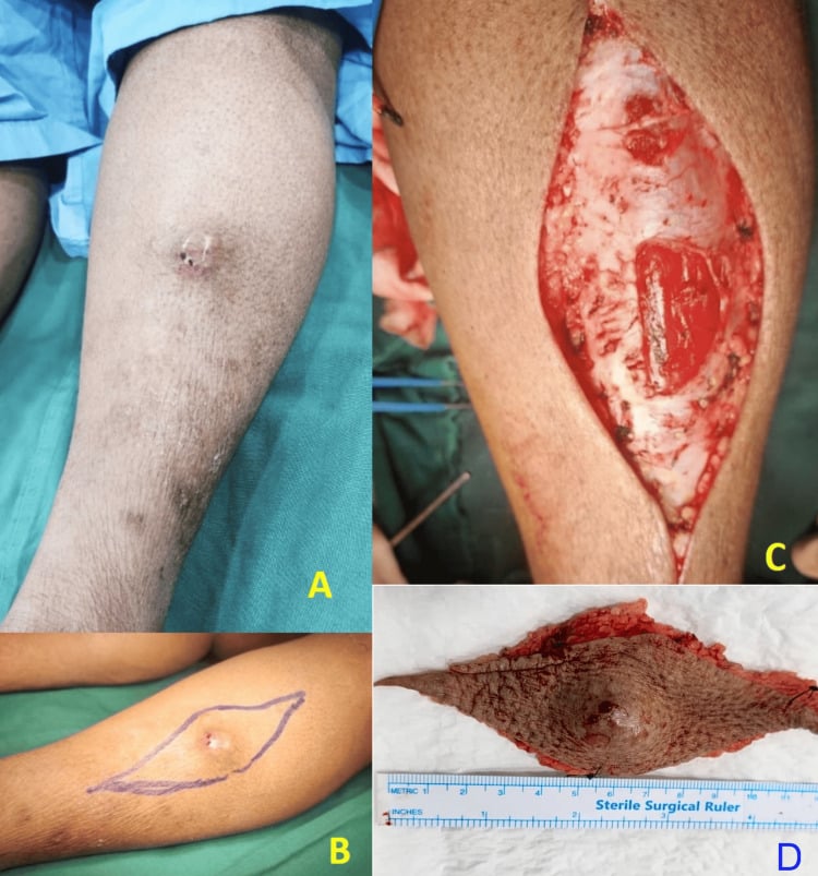 Clinical photographs of a leg soft-tissue mass, planned excision margins, the wound bed after wide excision and the specimen