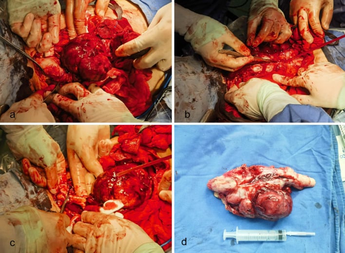 Intraoperative photographs of a large thigh sarcoma infiltrating the sciatic nerve, resected en bloc with the nerve