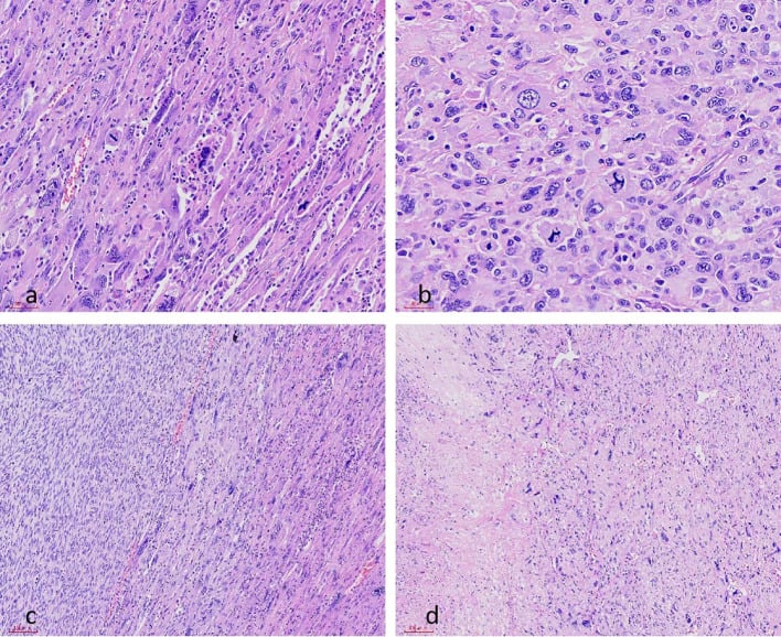 Histology showing mitotic figures at two magnifications, pleomorphic multinucleated areas and tumour necrosis
