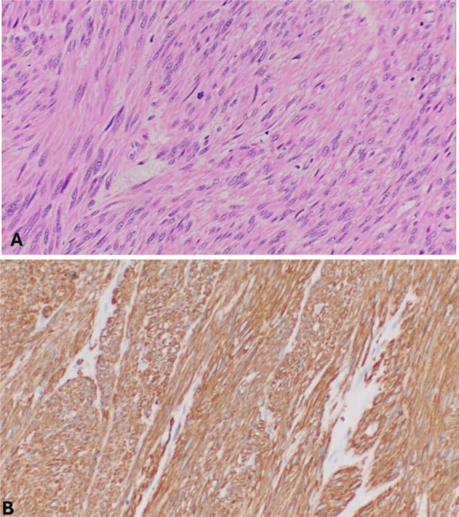 H&E histology of leiomyosarcoma spindle cells with nuclear atypia beside strong smooth muscle actin immunostaining