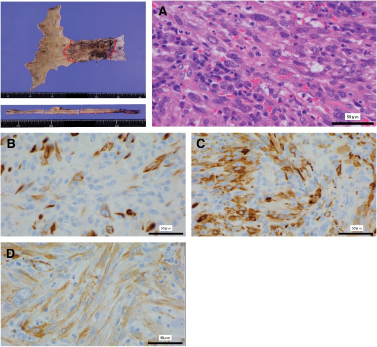 Immunohistochemistry panel showing desmin, h-caldesmon and alpha smooth muscle actin positivity in a spindle cell sarcoma