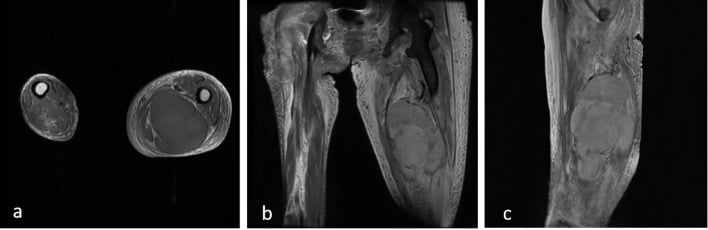 Axial, coronal and sagittal MRI showing a large deep soft-tissue mass in the posteromedial thigh