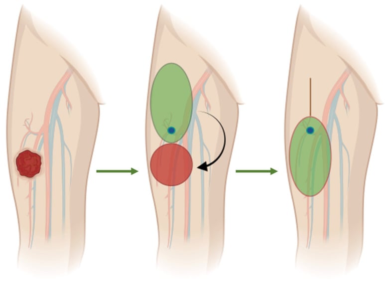 Schematic of perforator-based propeller flap reconstruction of a thigh defect after sarcoma excision