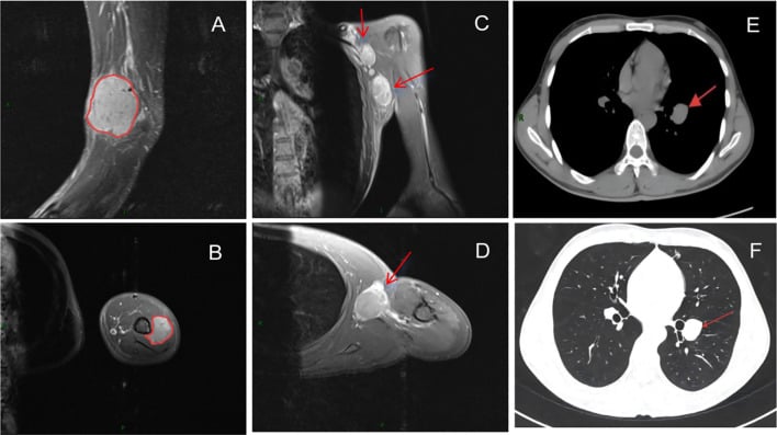 MRI of recurrent tumour in the cubital fossa and triceps with axillary nodal disease and chest CT showing bilateral pulmonary metastases