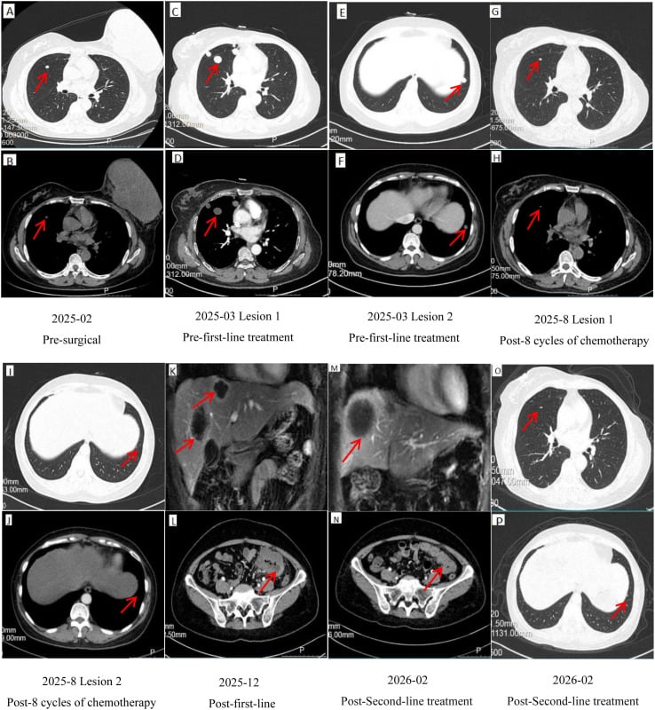 Serial chest CT lung and mediastinal windows tracking pulmonary lesions before and after successive lines of chemotherapy
