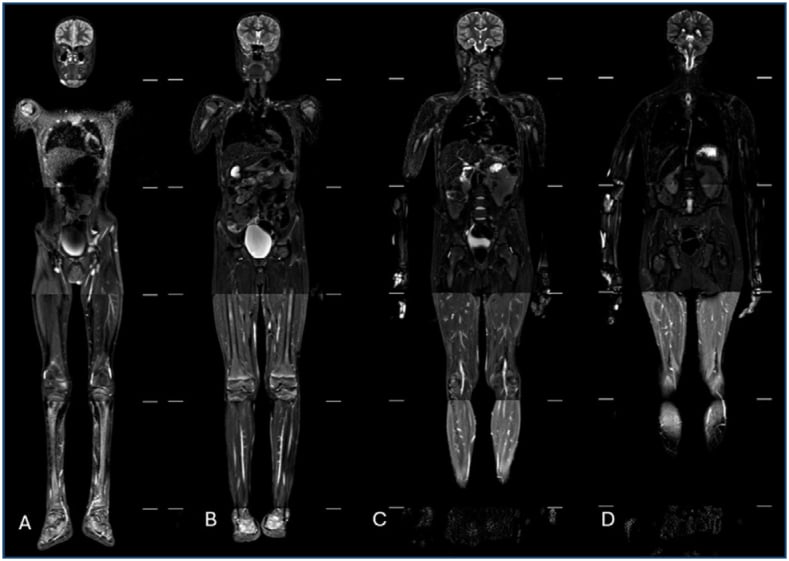 Consecutive coronal whole-body MRI STIR images showing no recurrence or metastasis on follow-up