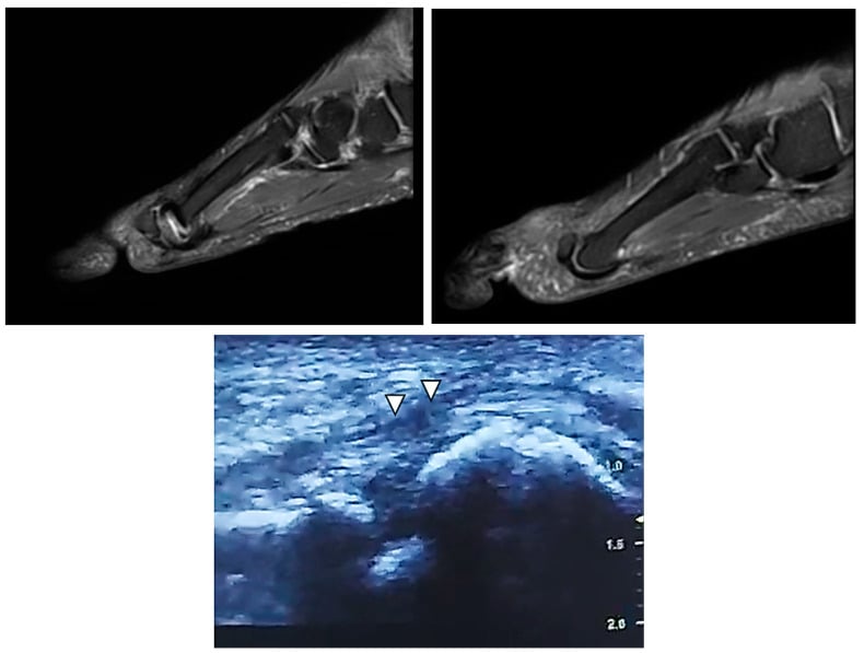 Sagittal T2-weighted MRI showing a partial second MTP plantar plate tear, a normal comparator MRI of the adjacent third MTP joint, and a longitudinal ultrasound showing a full-thickness plantar plate defect.