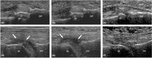 Six-panel high-frequency ultrasound of lesser-toe joints: the metatarsophalangeal joint (metatarsal to proximal phalanx, bottom row) and an interphalangeal joint (top row), with arrows marking synovitis.