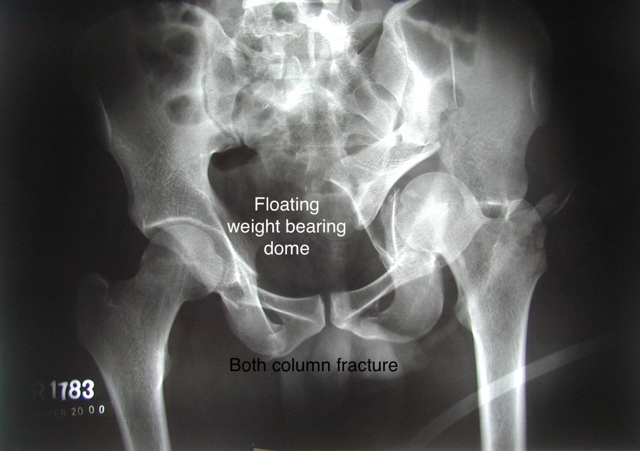AP pelvis radiograph of a both-column acetabular fracture with the weight-bearing dome dissociated from the axial skeleton.