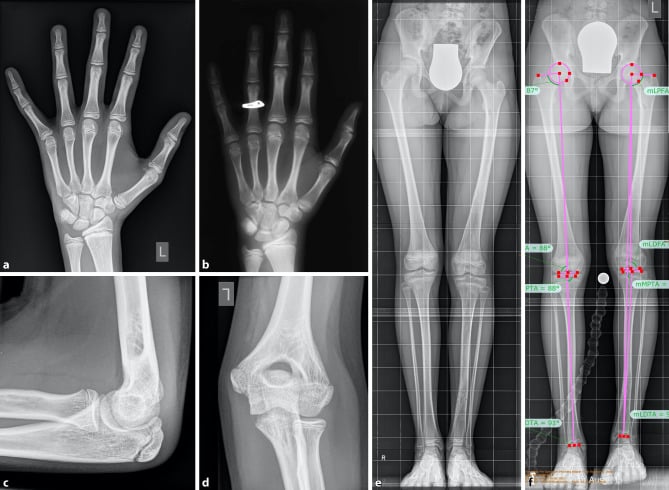 Hand and elbow radiographs used for skeletal bone-age assessment before epiphysiodesis