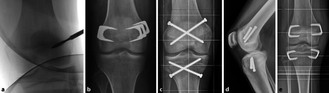 Comparison of Canale drilling, Blount staples, transphyseal screws and a physeal tether for epiphysiodesis