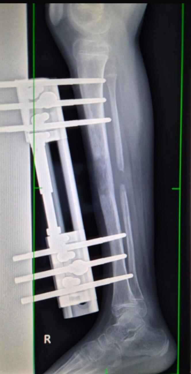 Lateral tibial radiograph during monolateral external-fixator lengthening with regenerate formation