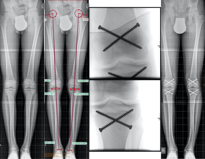 Standing alignment radiographs and fluoroscopic views of bilateral distal femoral and proximal tibial transphyseal screws