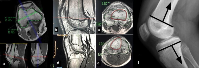 Volumetric MRI measurements of anterior and posterior distal femoral and proximal tibial physeal areas