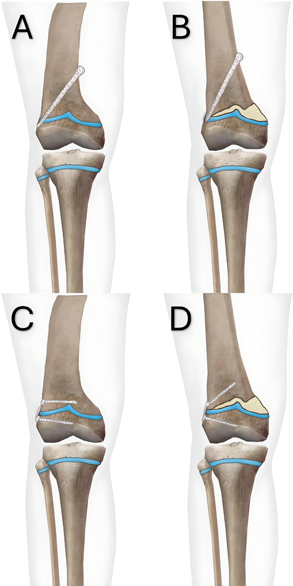 Four mechanisms of physeal tethering with a transphyseal screw or tension-band plate