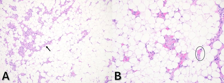 Two histology panels (A, B) of angiolipoma showing mature adipocytes and small vessels, marked by an arrow in A and a ring in B