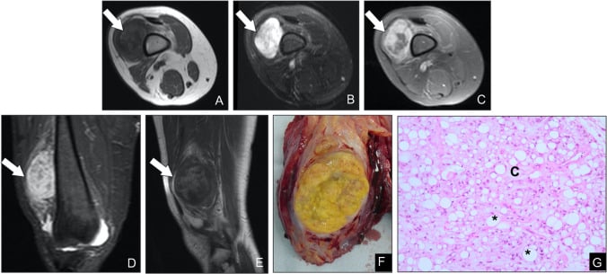 MRI panels (A-E) with arrows on the mass, gross specimen (F) and histology (G) of a chondroid lipoma