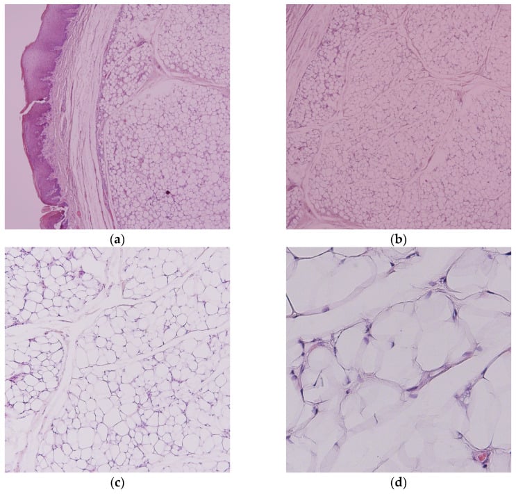 Four histology panels (a-d) of an encapsulated conventional lipoma composed of mature adipocytes and delicate fibrous septa, at low and higher power