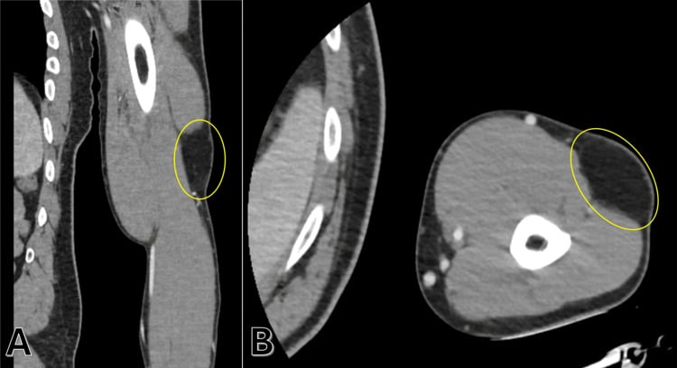 Two CT panels (A, B) with a homogeneous subcutaneous fatty mass in the upper arm ringed in yellow