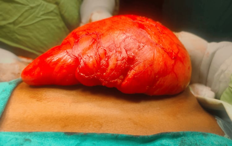 Operative photograph showing enucleation of a giant encapsulated lipoma