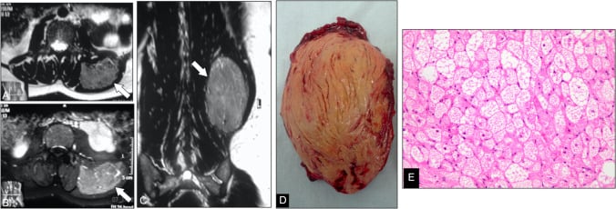 MRI panels (A-C) with arrows on the mass, gross specimen (D) and histology (E) of a hibernoma