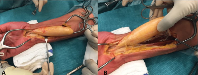 Two operative photographs (A, B) of fascicle-sparing dissection of a median-nerve intraneural lipoma