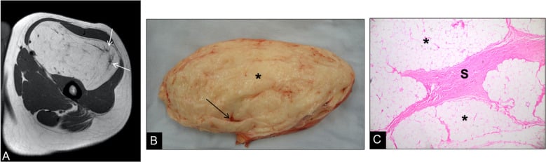 MRI (A), gross specimen (B) and histology (C) of a longstanding intramuscular lipoma with thick involutional septa