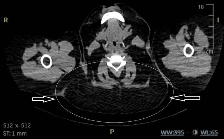 Axial CT with an ellipse and arrows marking symmetric unencapsulated fat posteriorly around the neck in Madelung disease
