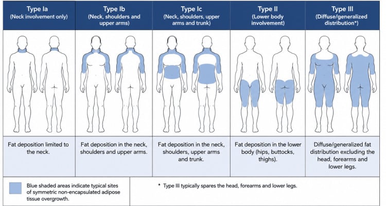 Phenotypic classification diagram of benign symmetric lipomatosis showing five fat-distribution patterns, Types Ia, Ib, Ic, II and III
