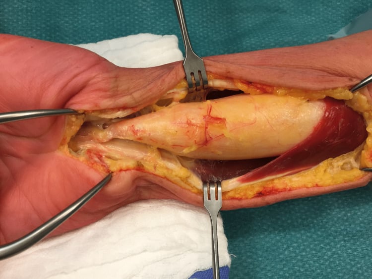 Operative photograph showing a fusiform lipoma within the median nerve sheath
