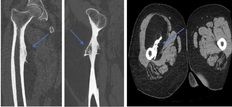 Three CT panels with arrows on a fat-density parosteal lipoma and its bony excrescence from the femur