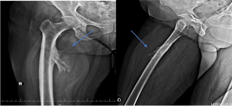Two thigh radiographs with arrows on a parosteal lipoma showing mineralisation and periosteal reaction beside the proximal femur