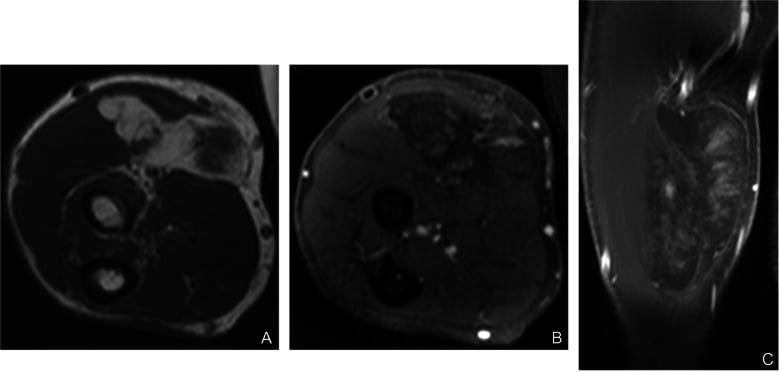 Three MRI panels (A-C) of a heterogeneous spindle-cell pleomorphic lipoma