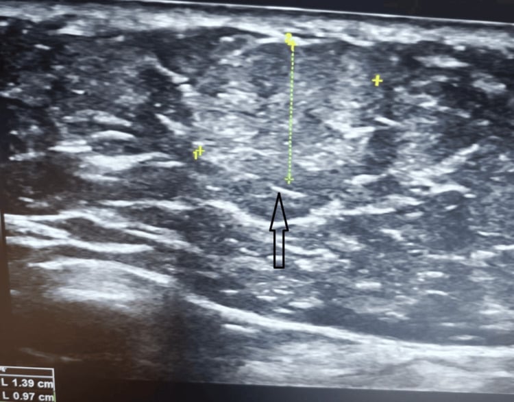 Targeted ultrasound showing a well-defined subcutaneous lipoma in the abdominal wall, with calliper measurements and an arrow at its deep margin